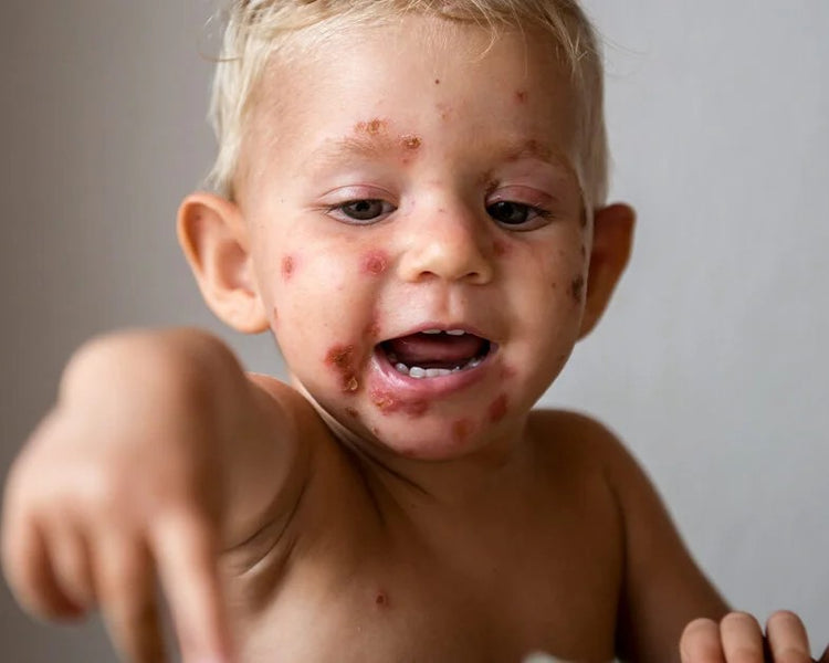 Impetigo - Treatment Services - McCartans Pharmacy Newry